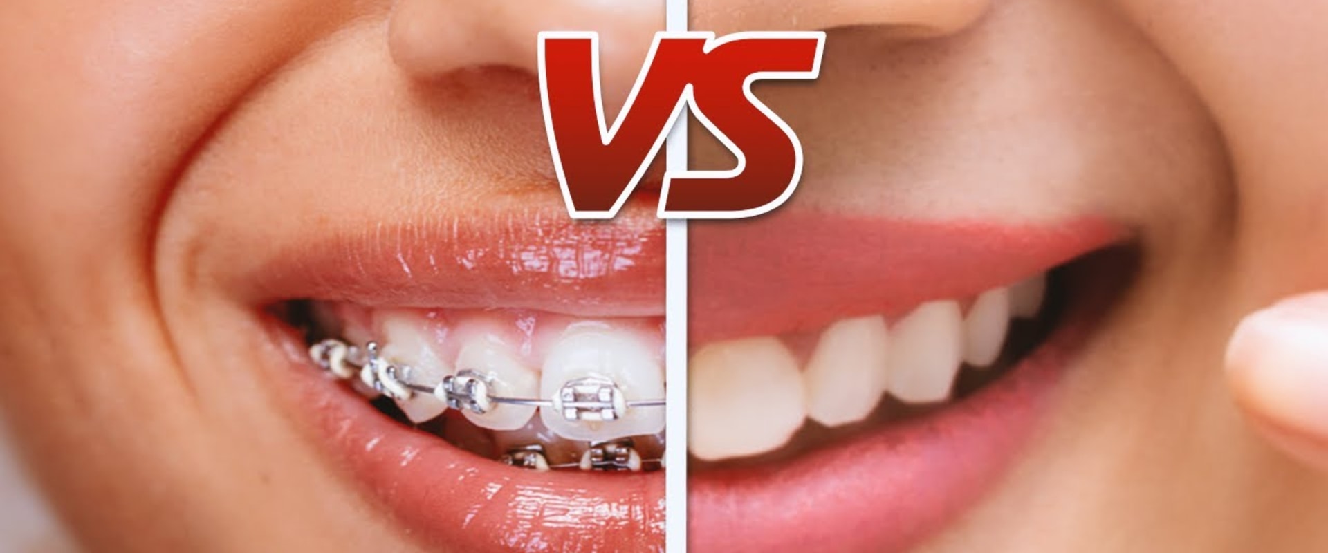 Understanding the Limitations of Invisalign Compared to Braces