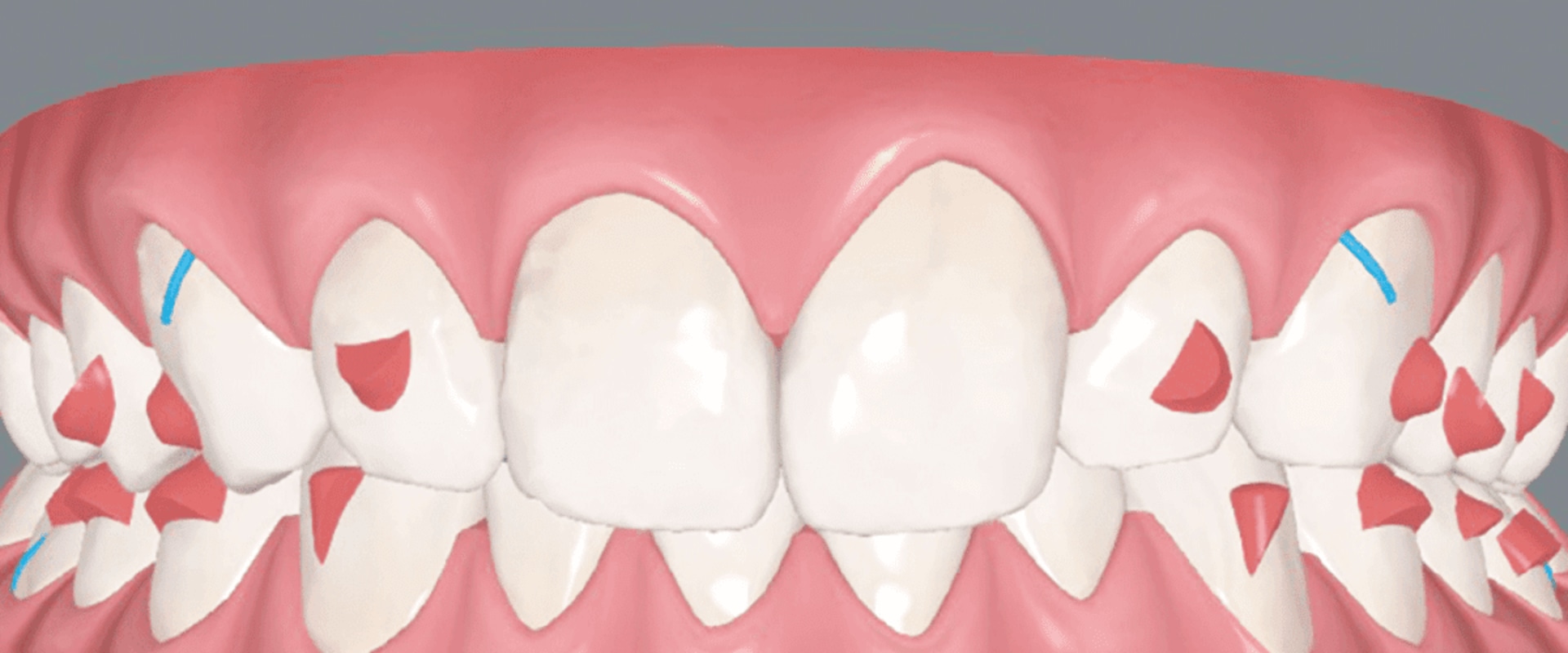 Clinical Studies on Invisalign: What You Need to Know
