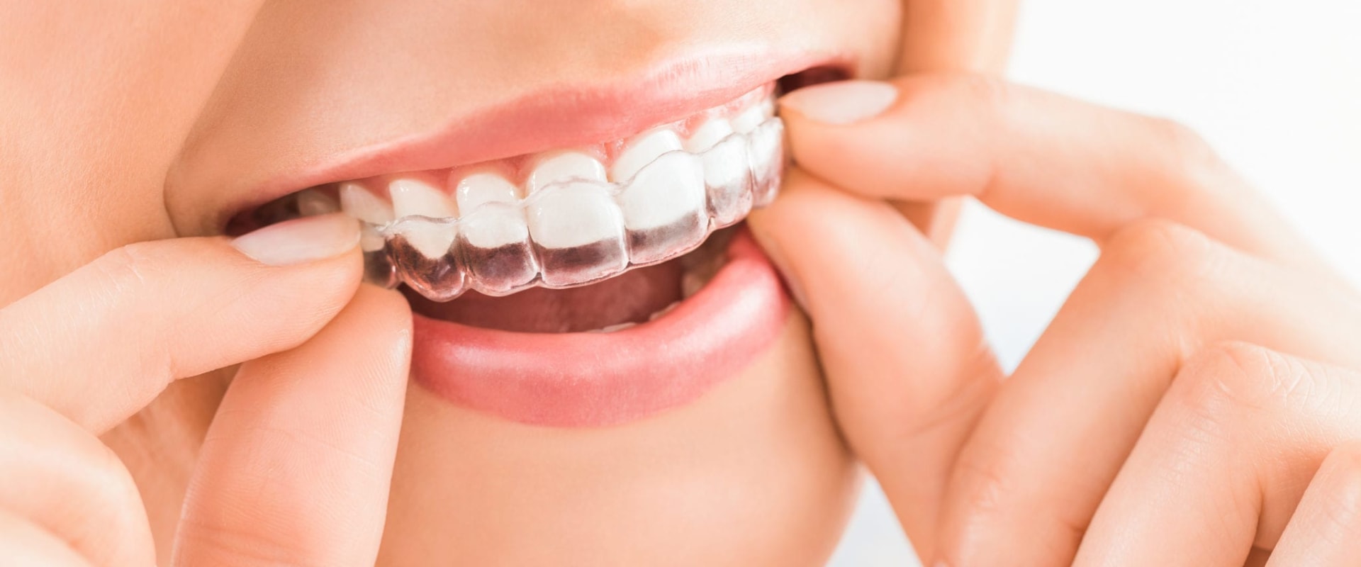 Tips for Wearing Your Aligners Comfortably