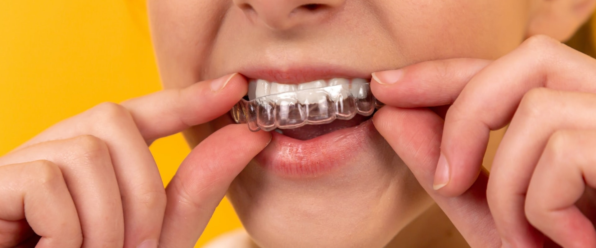 Advantages of Invisalign over Braces