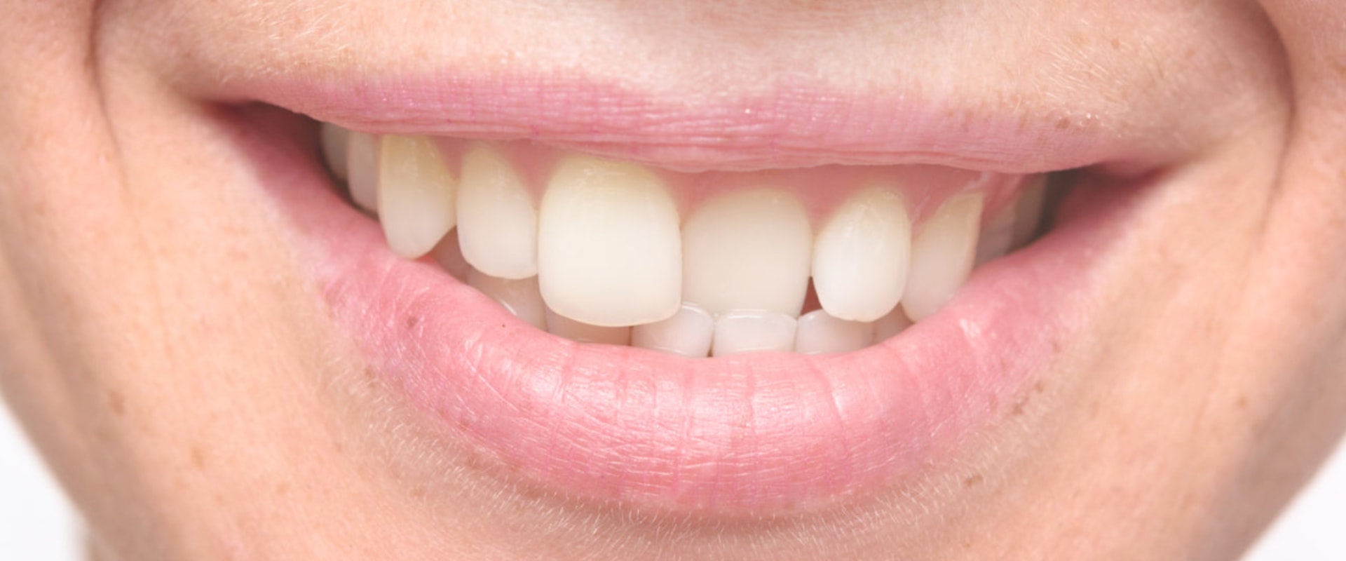 Non-Orthodontic Treatments for Crooked Teeth