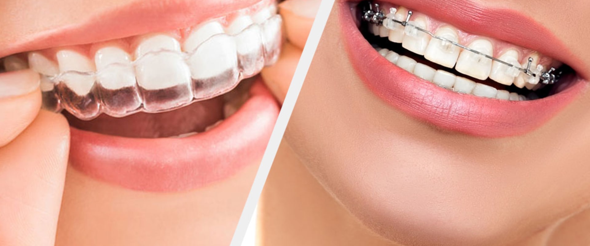 Clear braces vs. Invisalign for adults: Exploring the Best Option for You