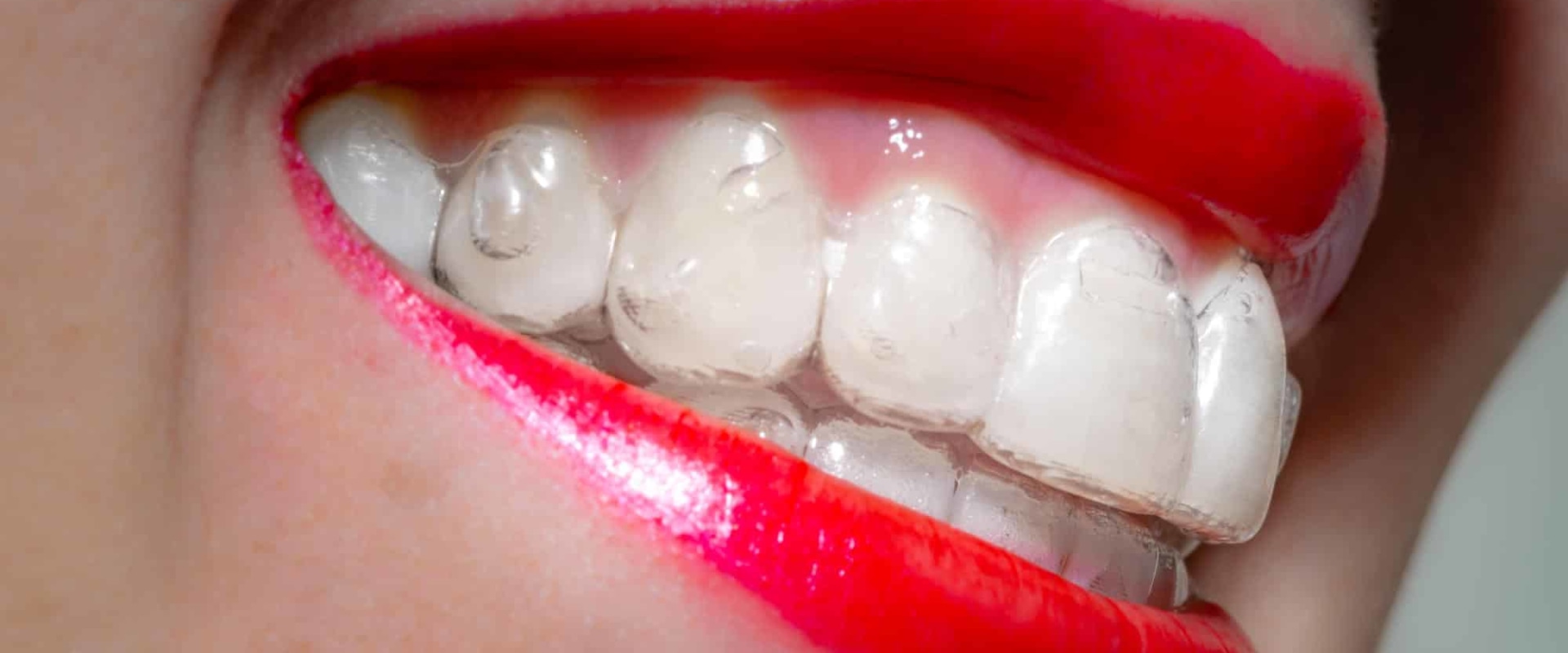 Uncovering Patient Stories and Experiences with Invisalign
