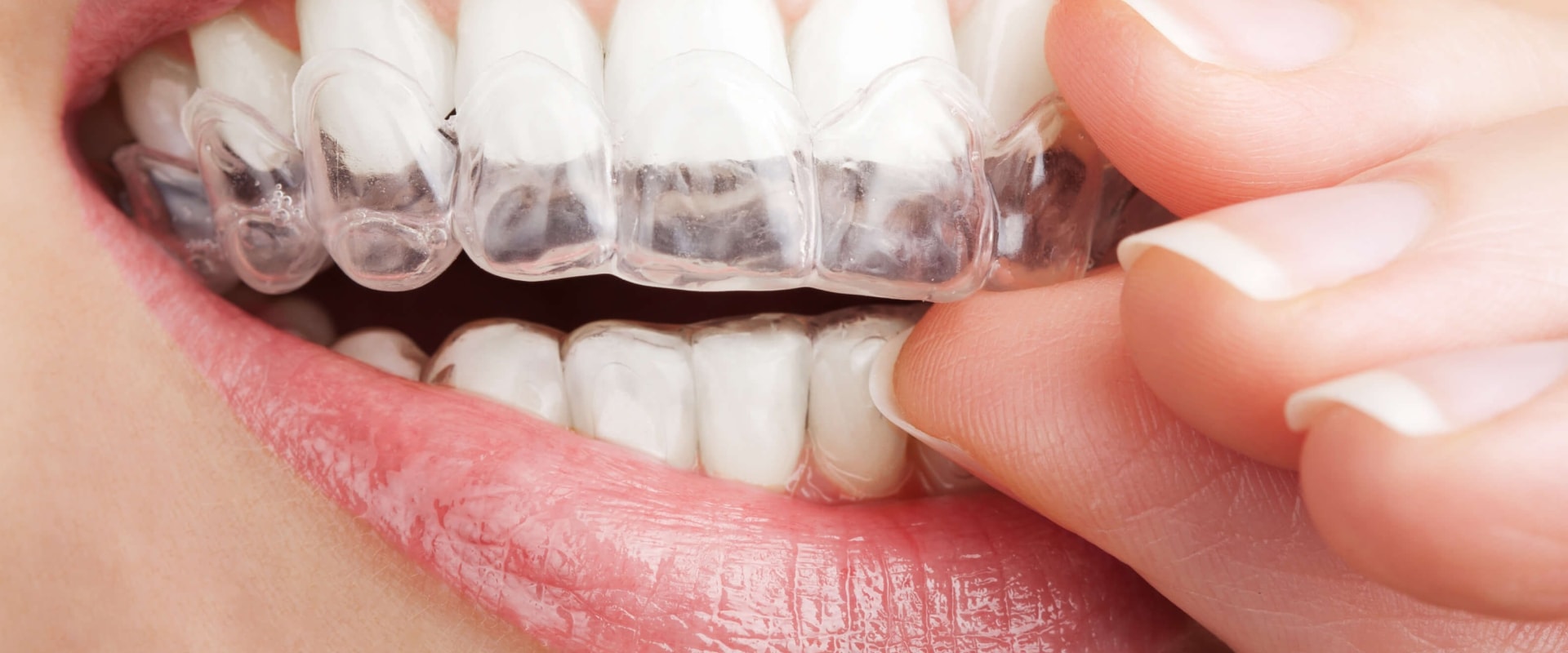 Third-Party Reviews of Invisalign