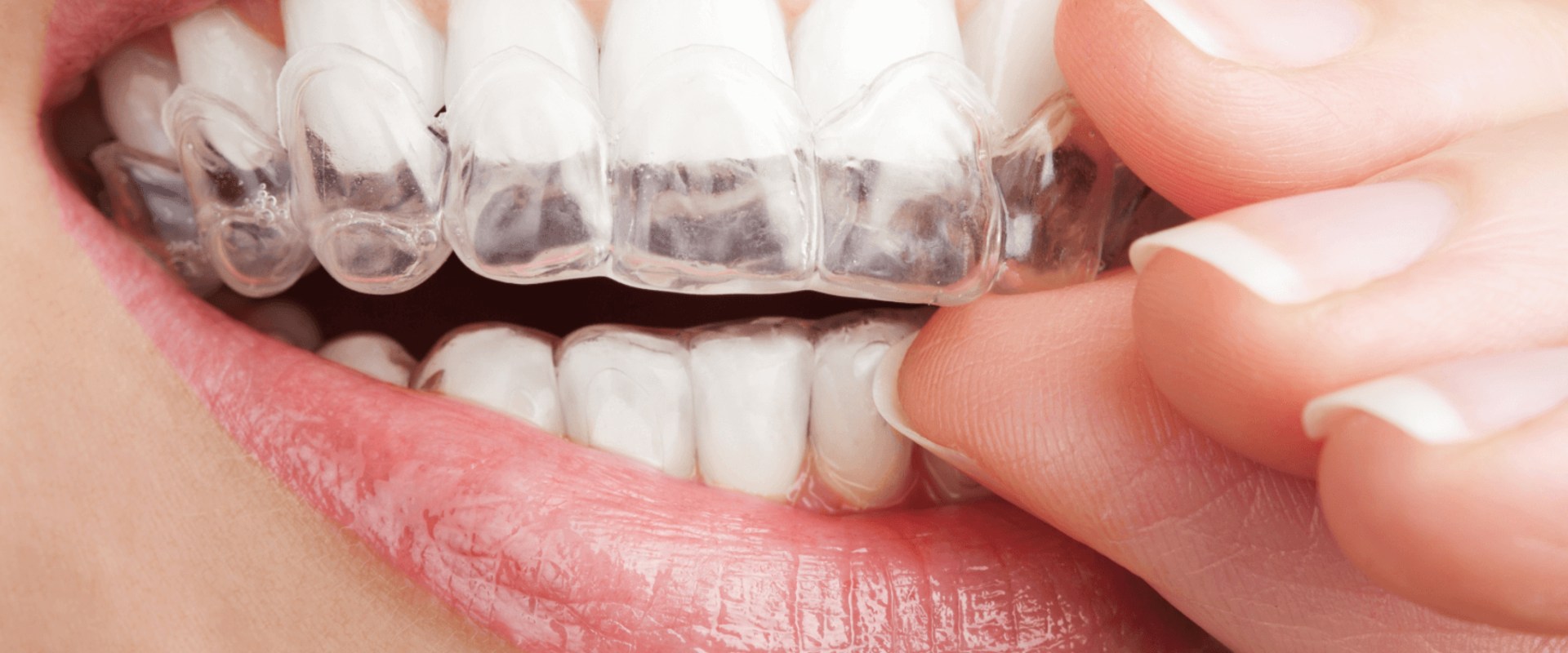 Benefits of Clear Aligners Over Metal Braces