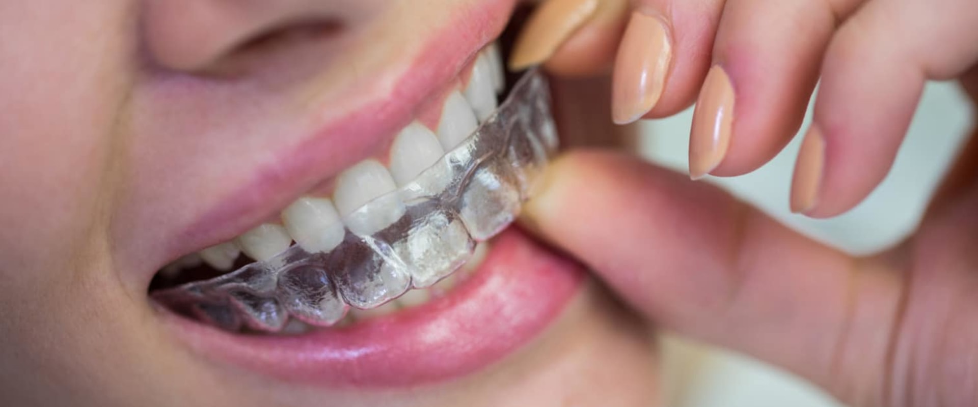 Everything You Need to Know About Dental Savings Plans for Invisalign