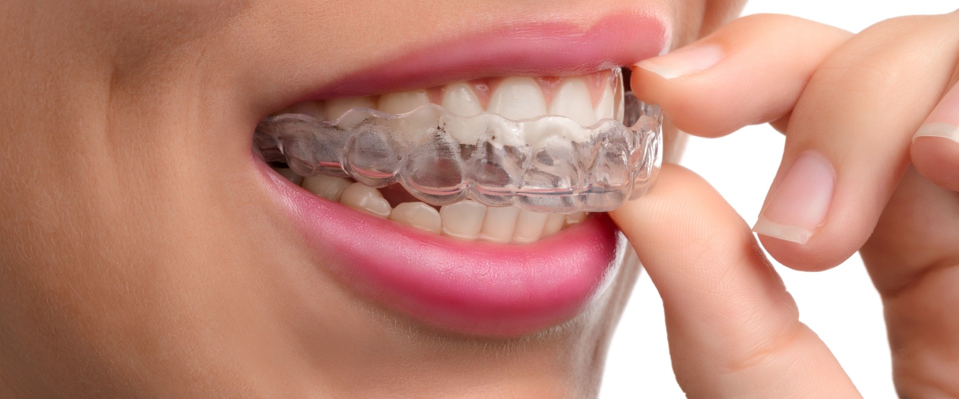 Cost of Invisalign in the US