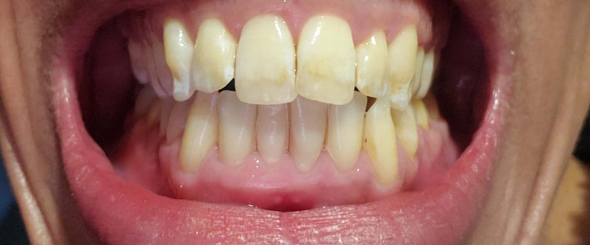 Online Ratings of Invisalign