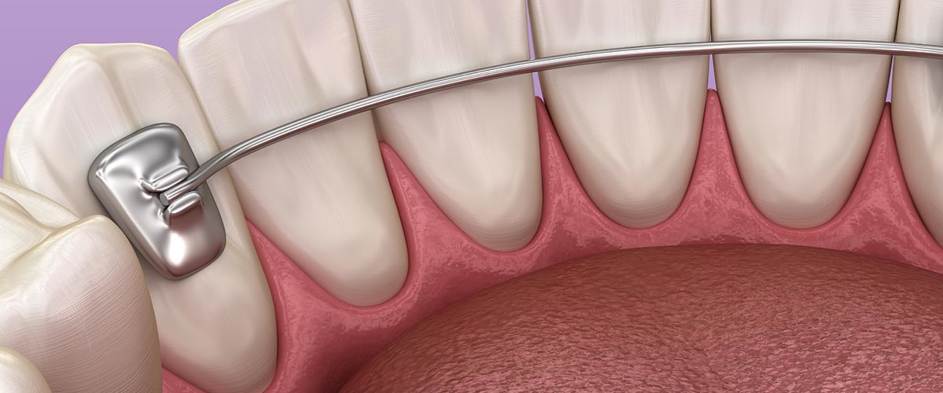 Retainers as an Alternative to Clear Aligners