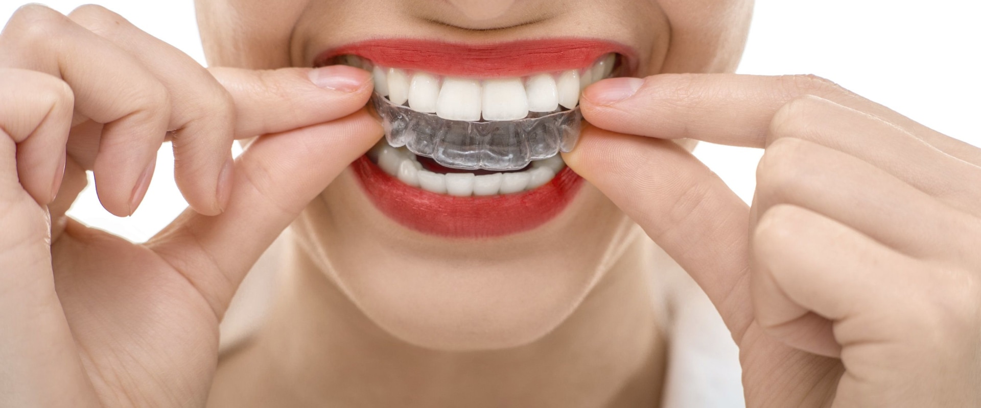 Adjusting to Wearing Aligners