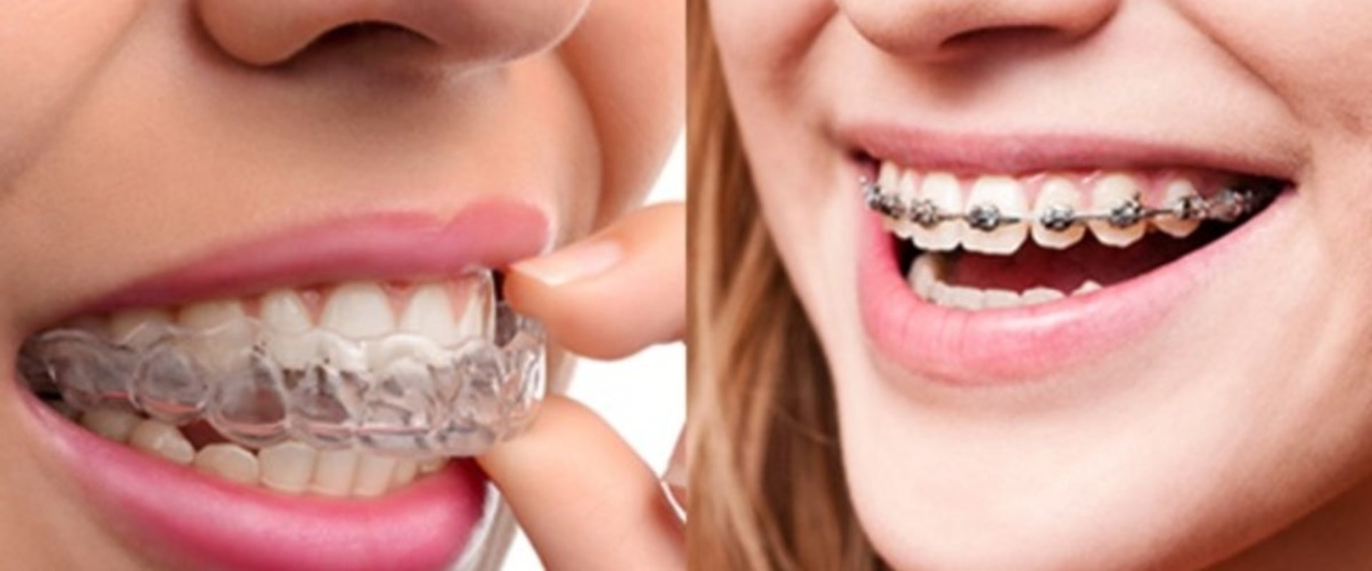 Pros and Cons of Traditional Braces vs Invisalign