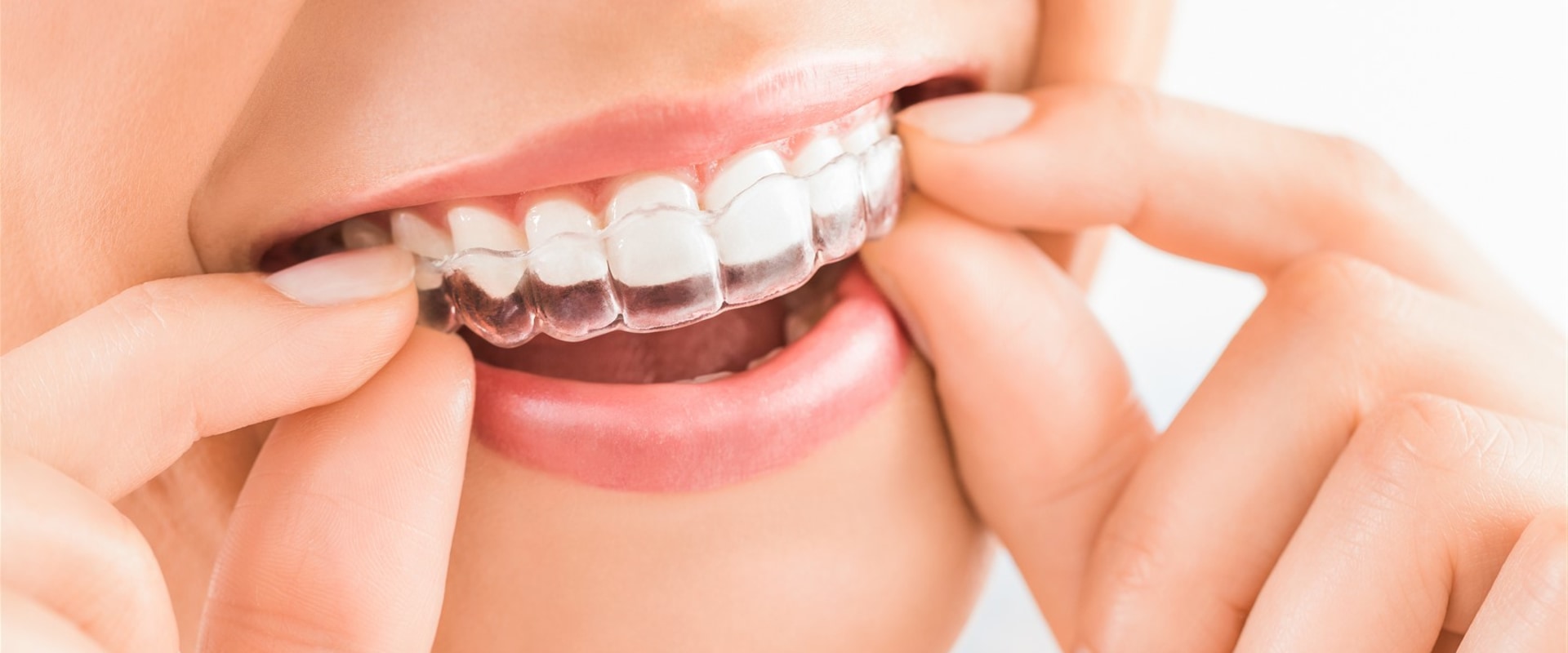 What Does Invisalign Cost in Canada?