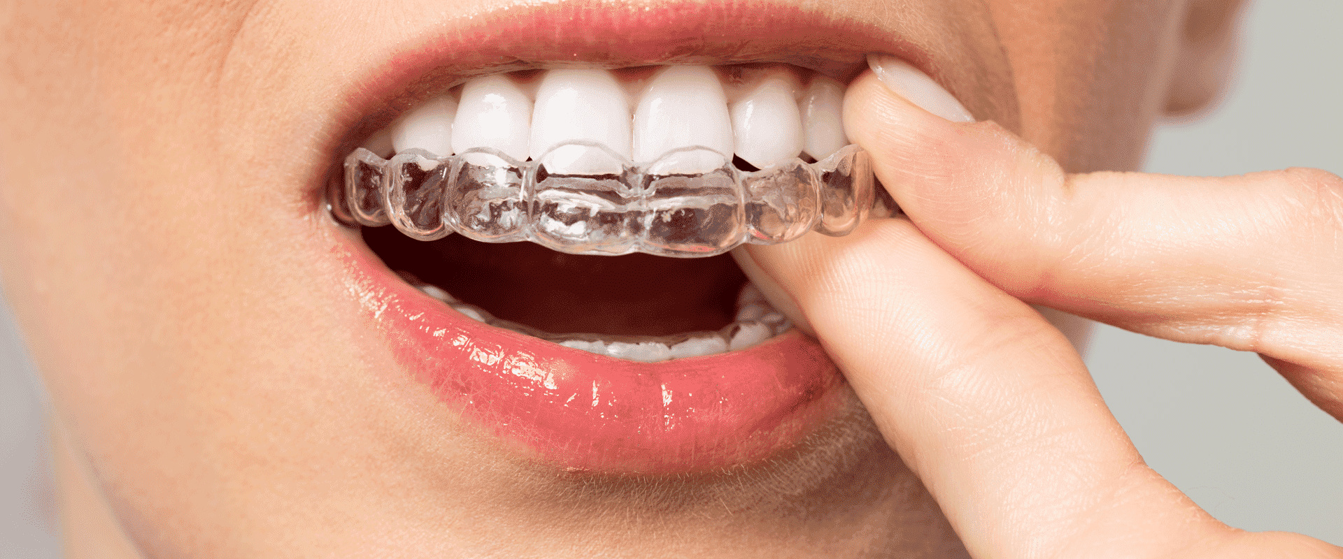 Invisalign Treatment Process: An Overview