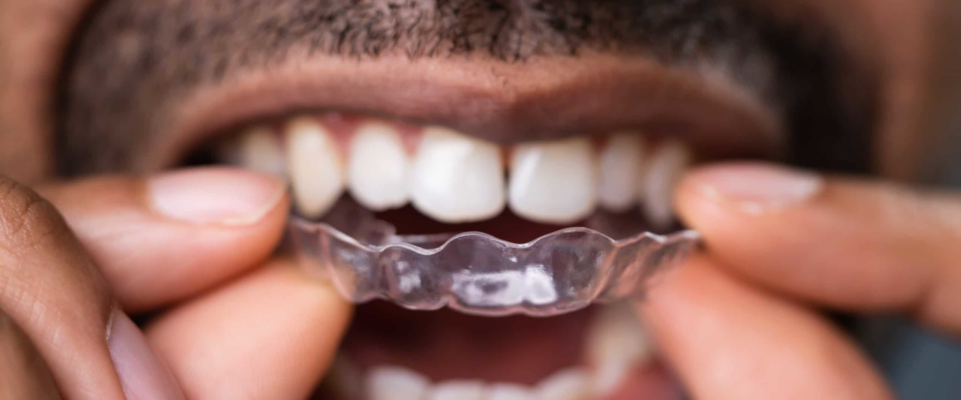Oral Health Professionals' Advice on Invisalign