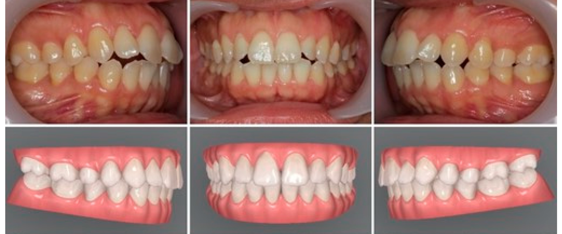 Research on the Effectiveness of Invisalign