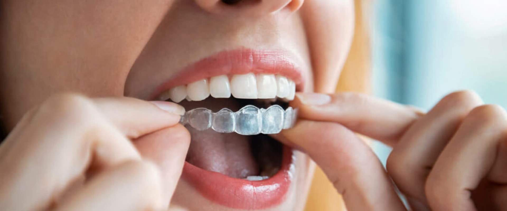 Invisalign Savings Programs: Exploring Your Options