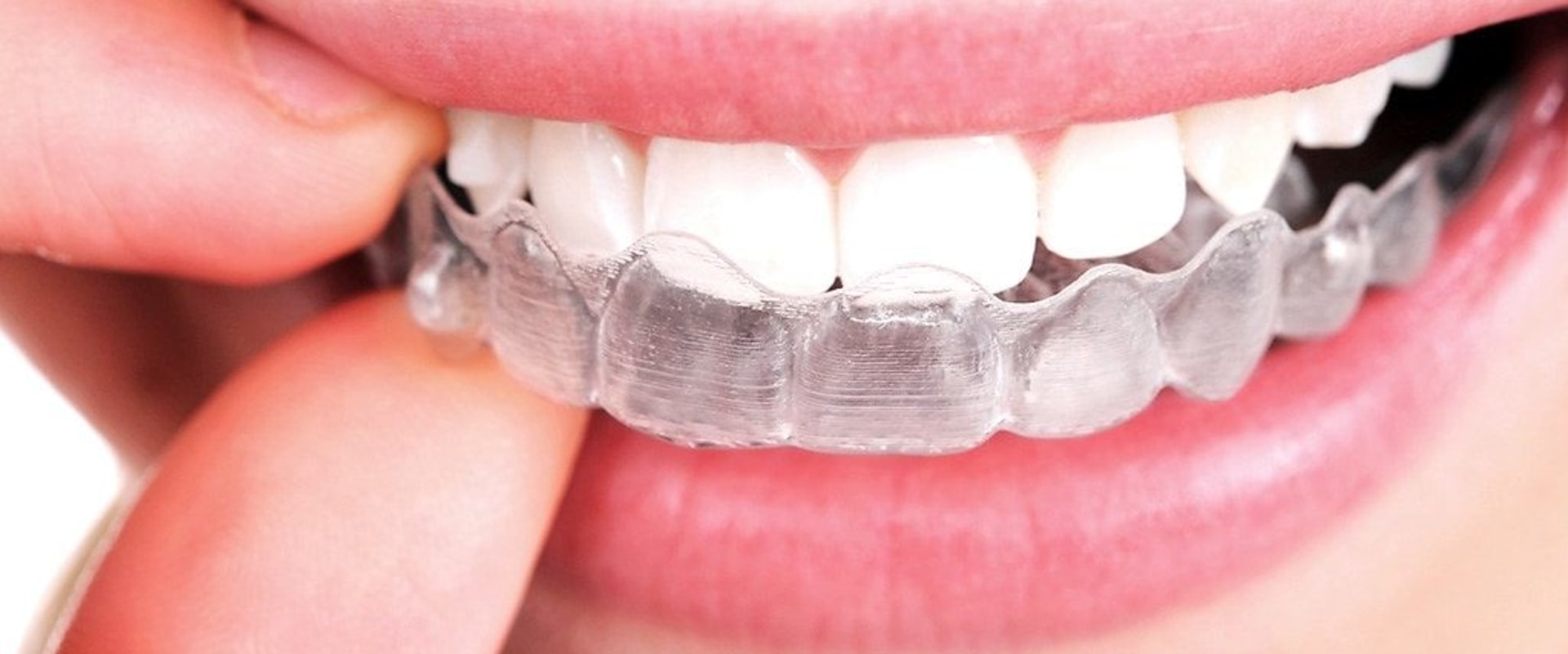 Alternative Treatments for Teeth Straightening