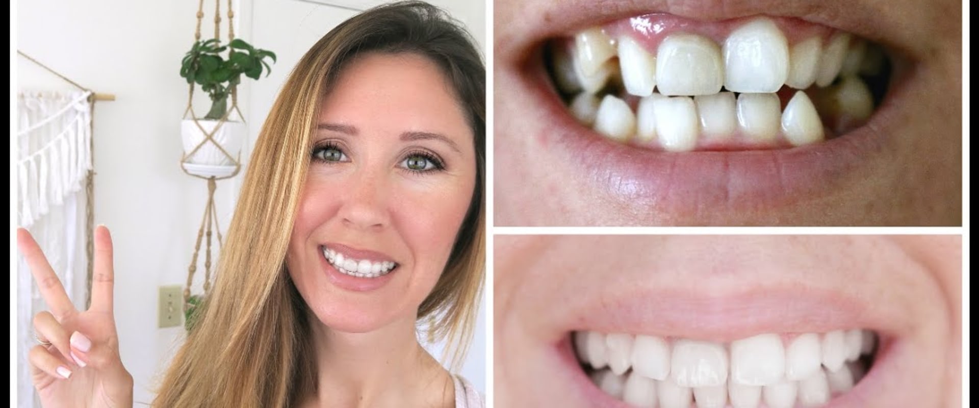 Before and After Photos of Invisalign Patients