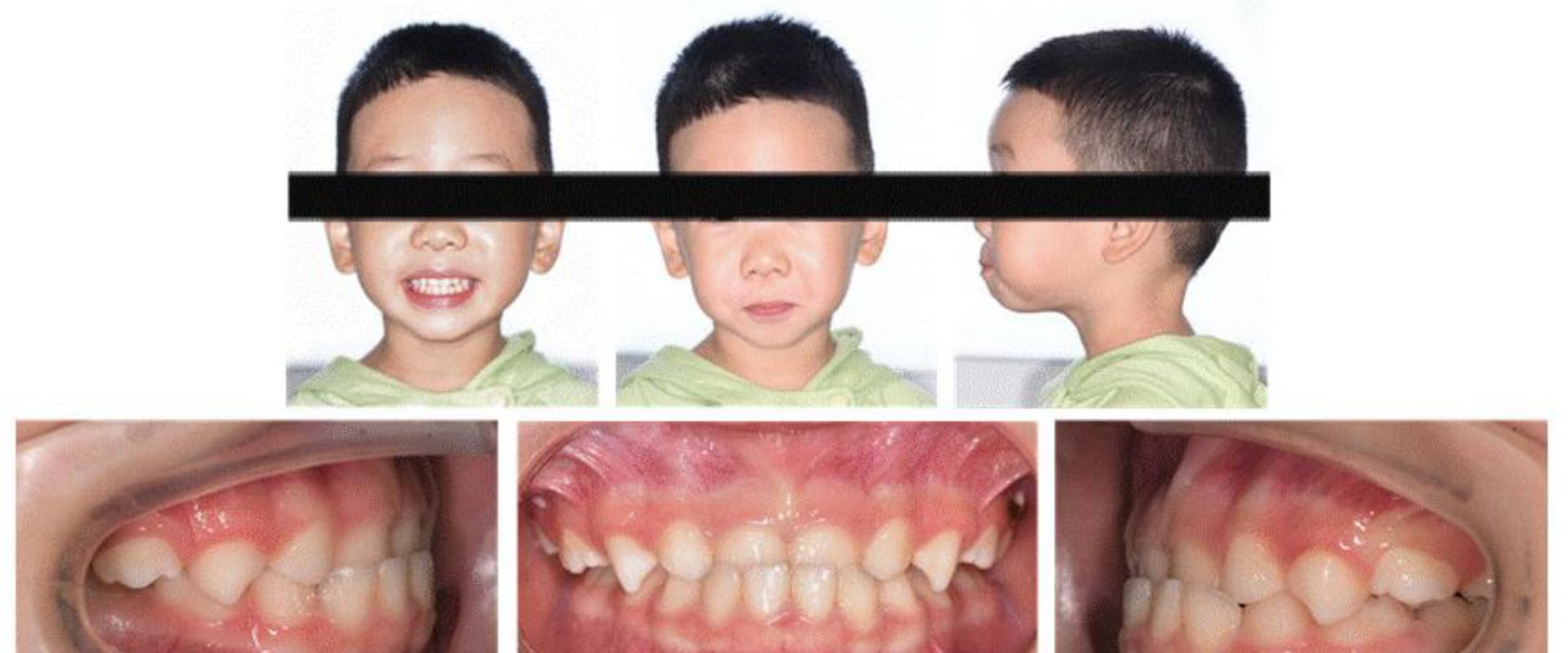 Successful Invisalign Treatments: Case Studies and Patient Photos