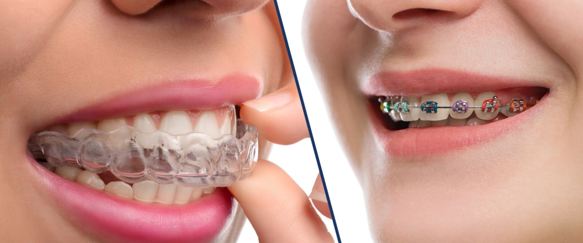 Exploring Expert Opinions on the Effectiveness of Invisalign