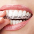 Understand the Risks Associated with Clear Aligners