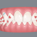 Clinical Studies on Invisalign: What You Need to Know