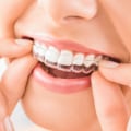 Tips for Wearing Your Aligners Comfortably