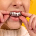 Advantages of Invisalign over Braces