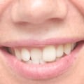 Non-Orthodontic Treatments for Crooked Teeth