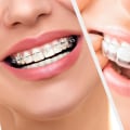 Clear braces vs. Invisalign for adults: Exploring the Best Option for You