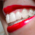 Uncovering Patient Stories and Experiences with Invisalign