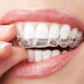 Benefits of Clear Aligners Over Metal Braces