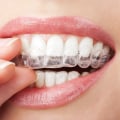 Duration of Invisalign Treatment