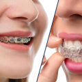 Benefits of Clear Aligners Over Metal Braces