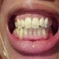 Online Ratings of Invisalign