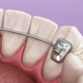 Retainers as an Alternative to Clear Aligners