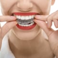 Adjusting to Wearing Aligners