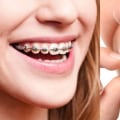 Pros and Cons of Traditional Braces vs Invisalign