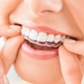 What Does Invisalign Cost in Canada?