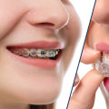 Comparing Traditional Metal Braces and Invisalign