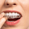 Invisalign Treatment Process: An Overview