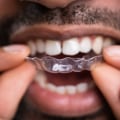 Oral Health Professionals' Advice on Invisalign