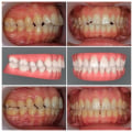 Research on the Effectiveness of Invisalign