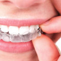 Alternative Treatments for Teeth Straightening