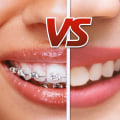 Comparing Clear Braces and Invisalign for Adults