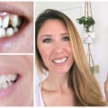 Before and After Photos of Invisalign Patients