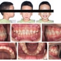 Successful Invisalign Treatments: Case Studies and Patient Photos