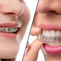 Exploring Expert Opinions on the Effectiveness of Invisalign