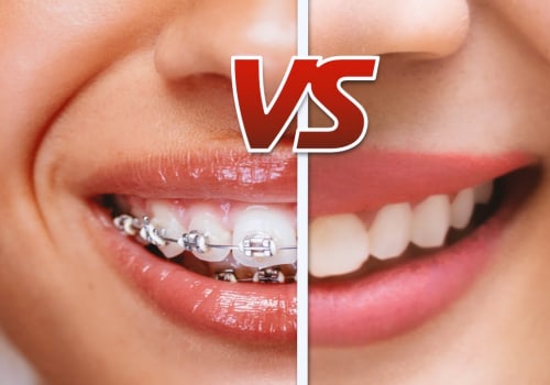 Understanding the Limitations of Invisalign Compared to Braces