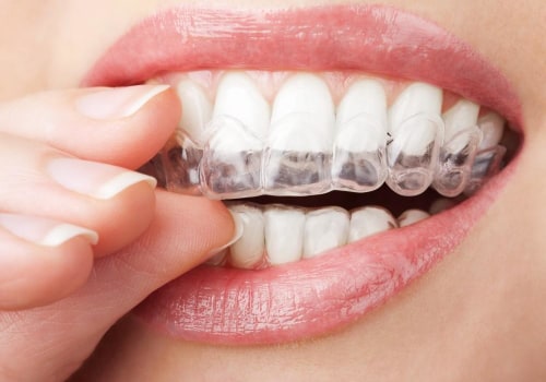Potential Side Effects of Invisalign Treatment